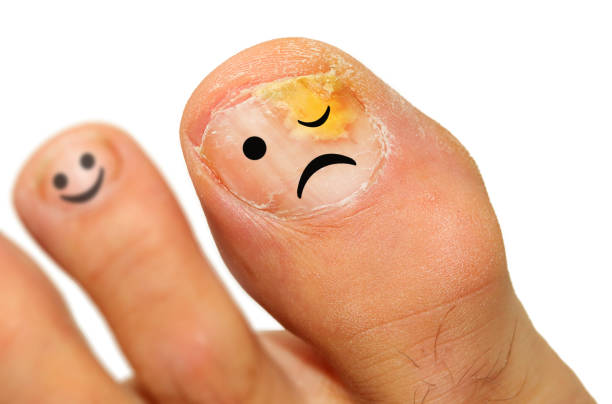 Fungal and Nail Infections: How to Prevent and Treat Them